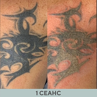 Фото до и после сведение татуировок